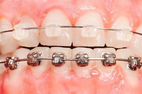 diferencia entre brackets metalicos y esteticos|brackets aesthetic pros y cons.